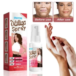 Vitiligo Relief Spray